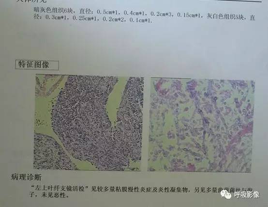 【病例】变应性支气管肺曲霉病1例CT影像表现 【病例】变应性支气管肺曲霉病1例CT影像表现