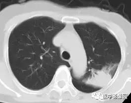 【病例】变应性支气管肺曲霉病1例CT影像表现 【病例】变应性支气管肺曲霉病1例CT影像表现
