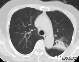 【病例】变应性支气管肺曲霉病1例CT影像表现 【病例】变应性支气管肺曲霉病1例CT影像表现