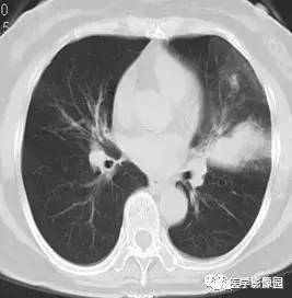 【病例】变应性支气管肺曲霉病1例CT影像表现 【病例】变应性支气管肺曲霉病1例CT影像表现