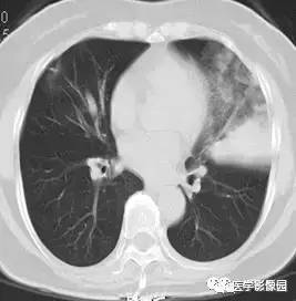 【病例】变应性支气管肺曲霉病1例CT影像表现 【病例】变应性支气管肺曲霉病1例CT影像表现
