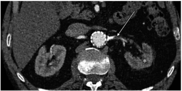 肾血管疾病影像诊断 肾血管疾病影像诊断
