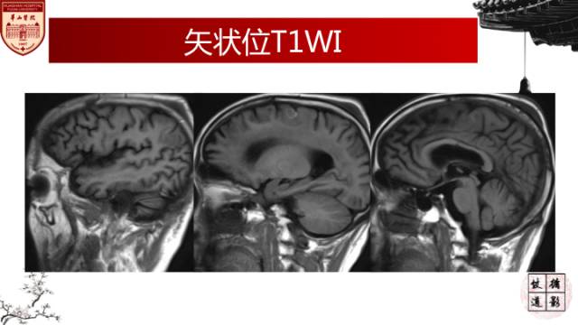 【病例】HIV弓形体脑病1例MR影像表现