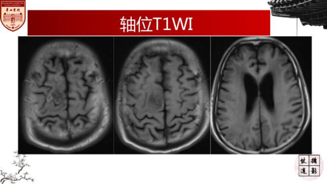 【病例】HIV弓形体脑病1例MR影像表现