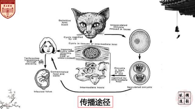 【病例】HIV弓形体脑病1例MR影像表现