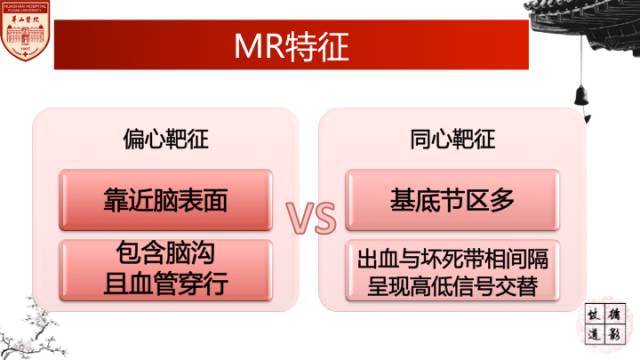 【病例】HIV弓形体脑病1例MR影像表现