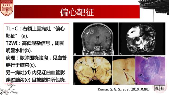 【病例】HIV弓形体脑病1例MR影像表现