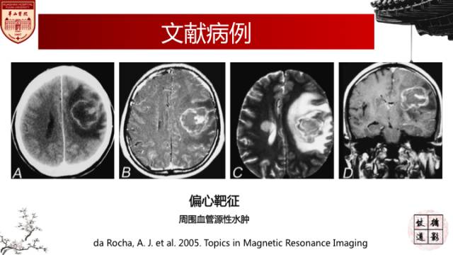【病例】HIV弓形体脑病1例MR影像表现