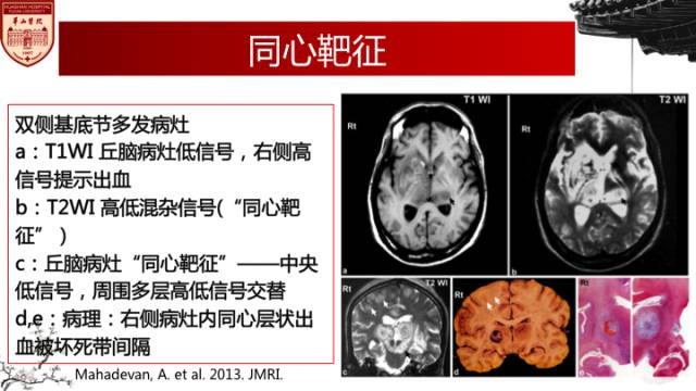 【病例】HIV弓形体脑病1例MR影像表现