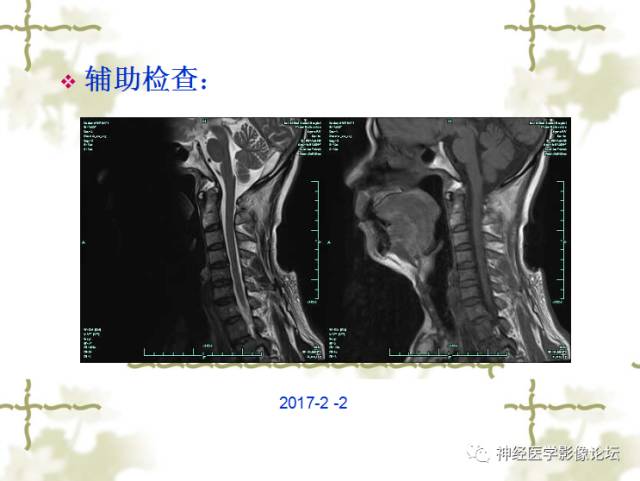 【病例】视神经脊髓炎一例MR