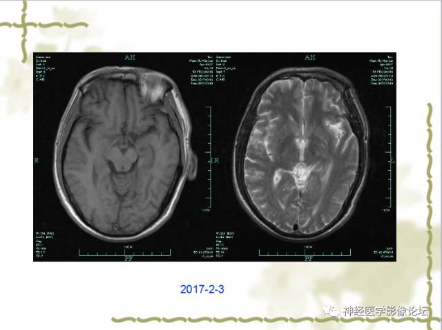 【病例】视神经脊髓炎一例MR
