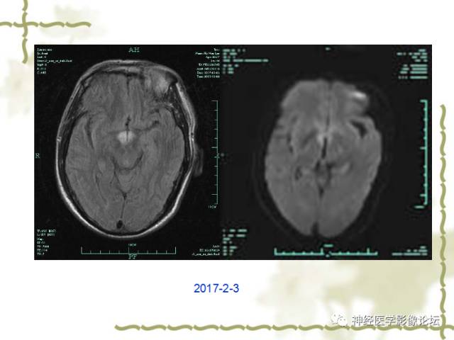 【病例】视神经脊髓炎一例MR