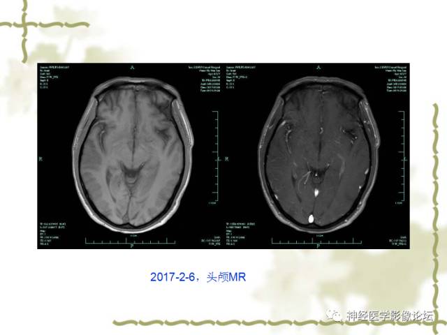 【病例】视神经脊髓炎一例MR