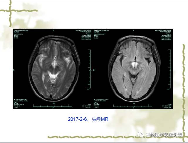 【病例】视神经脊髓炎一例MR