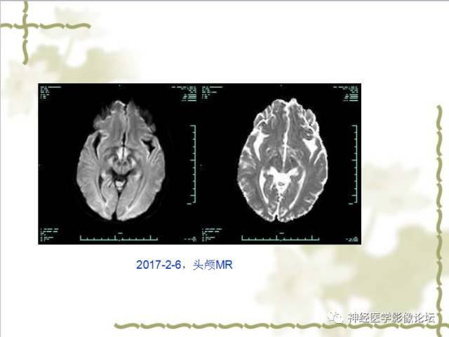 【病例】视神经脊髓炎一例MR