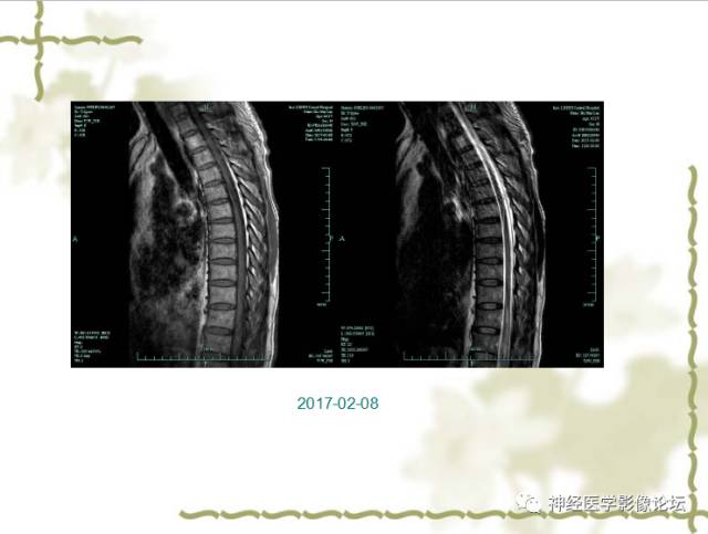 【病例】视神经脊髓炎一例MR