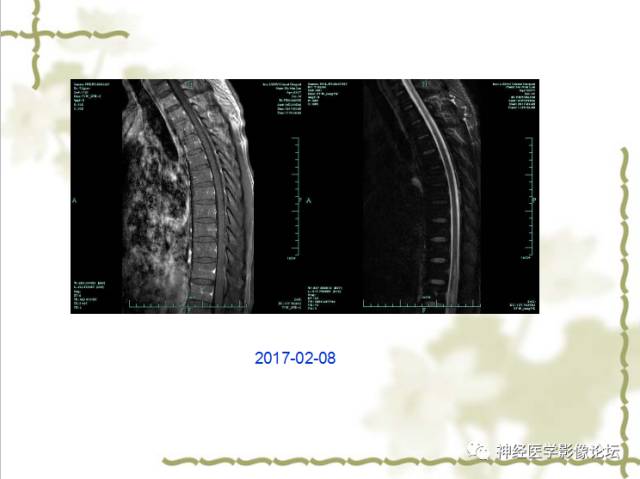【病例】视神经脊髓炎一例MR