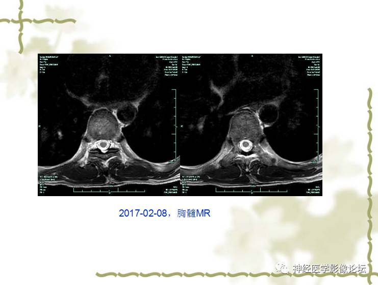 【病例】视神经脊髓炎一例MR