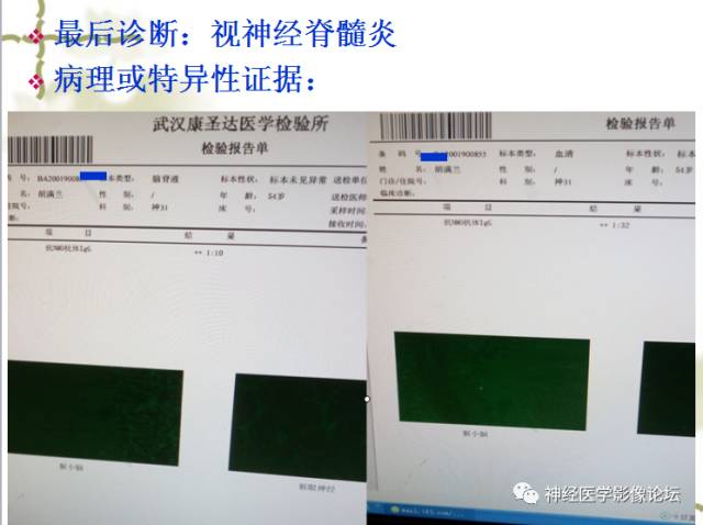 【病例】视神经脊髓炎一例MR