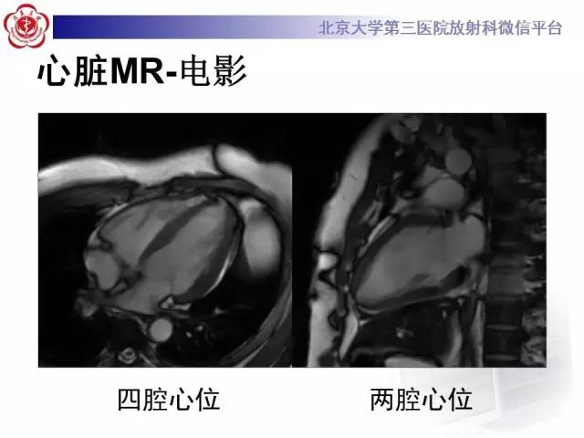 【病例】急性心肌炎1例CMR表现