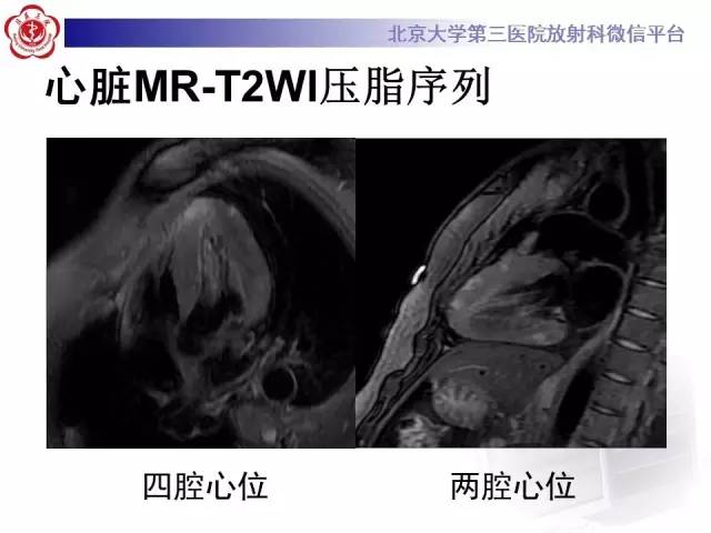 【病例】急性心肌炎1例CMR表现