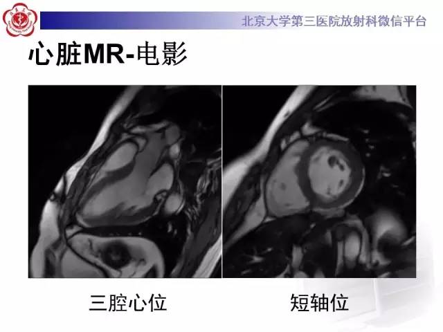 【病例】急性心肌炎1例CMR表现