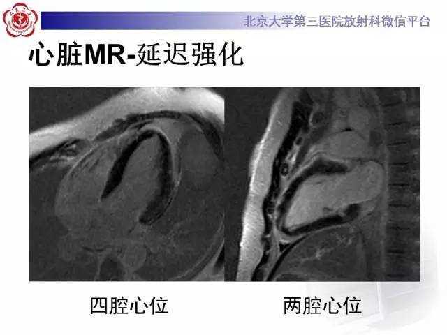 【病例】急性心肌炎1例CMR表现