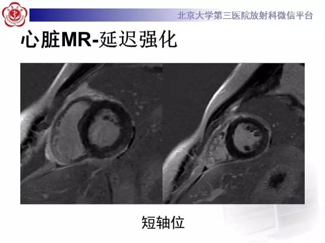 【病例】急性心肌炎1例CMR表现