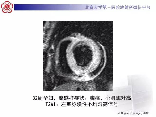 【病例】急性心肌炎1例CMR表现
