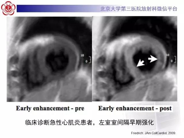 【病例】急性心肌炎1例CMR表现