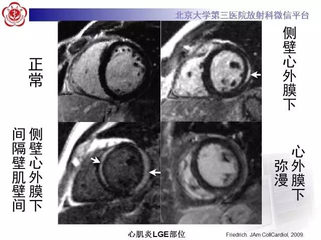 【病例】急性心肌炎1例CMR表现