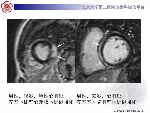 【病例】急性心肌炎1例CMR表现