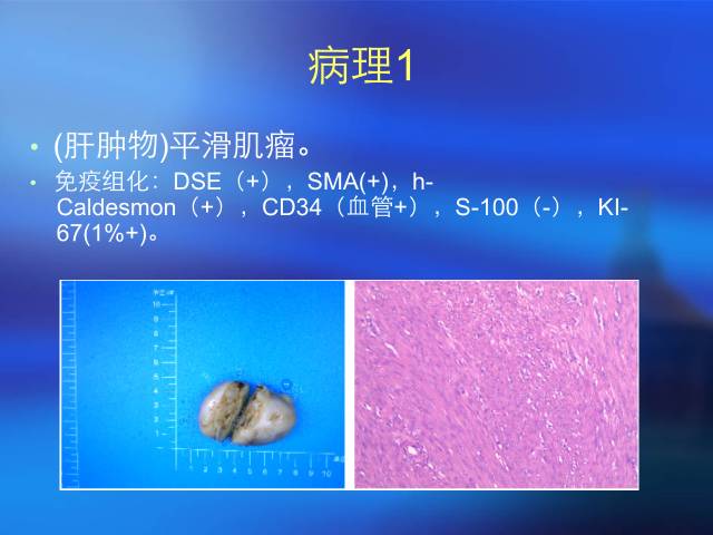 【病例】肝脏2例少见肿瘤——平滑肌瘤VS上皮样血管平滑肌脂肪瘤 【病例】肝脏2例少见肿瘤——平滑肌瘤VS上皮样血管平滑肌脂肪瘤