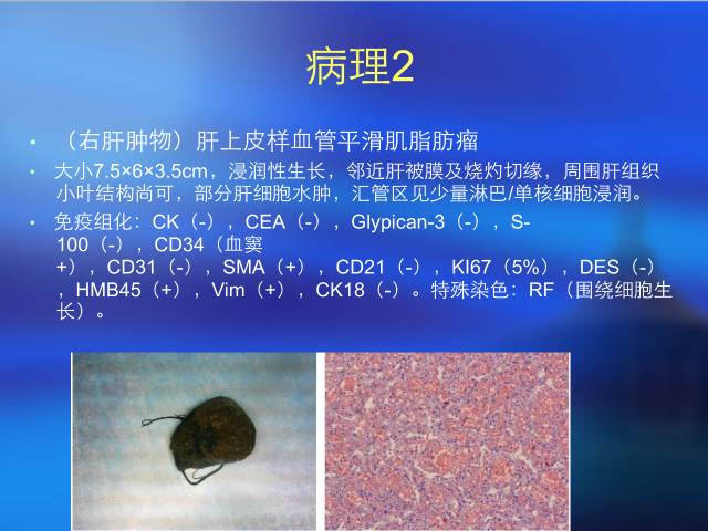 【病例】肝脏2例少见肿瘤——平滑肌瘤VS上皮样血管平滑肌脂肪瘤 【病例】肝脏2例少见肿瘤——平滑肌瘤VS上皮样血管平滑肌脂肪瘤