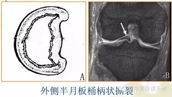 膝关节之半月板桶柄状撕裂