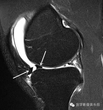 膝关节之半月板桶柄状撕裂 膝关节之半月板桶柄状撕裂