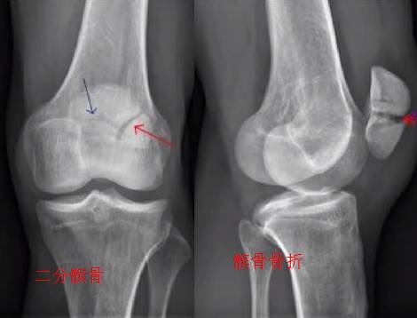 易被误诊为骨折的6个结构 易被误诊为骨折的6个结构