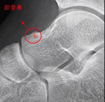 易被误诊为骨折的6个结构 易被误诊为骨折的6个结构