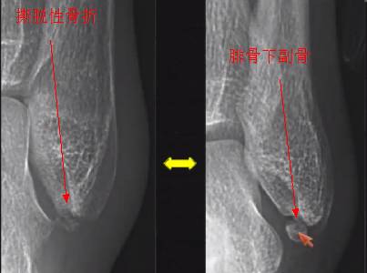 易被误诊为骨折的6个结构 易被误诊为骨折的6个结构