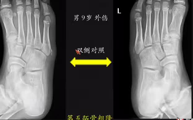 易被误诊为骨折的6个结构 易被误诊为骨折的6个结构