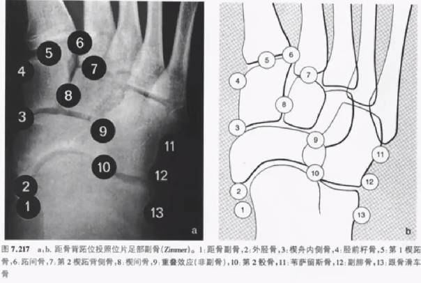 易被误诊为骨折的6个结构 易被误诊为骨折的6个结构