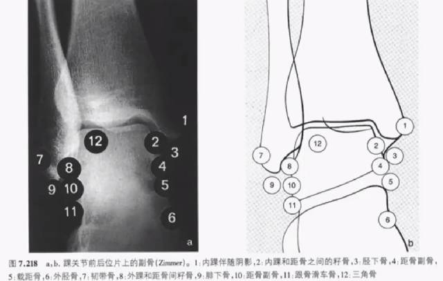 易被误诊为骨折的6个结构 易被误诊为骨折的6个结构
