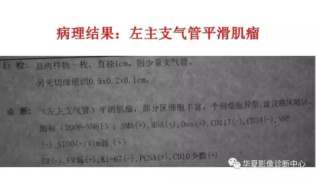 【病例】支气管平滑肌瘤1例CT影像表现