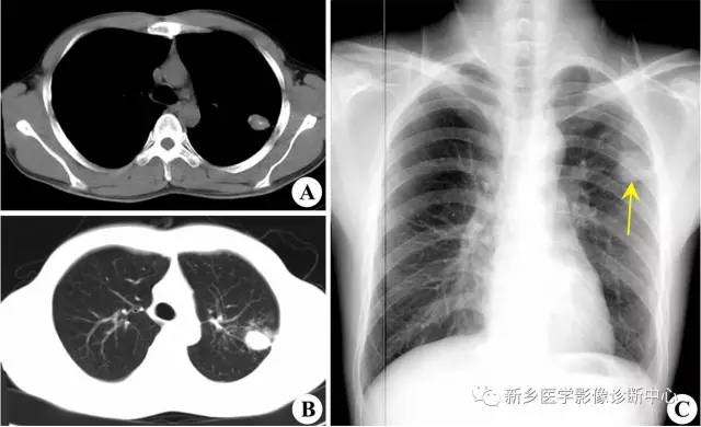 肺内单发球形病灶应想到的12种病