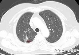 【病例】右肺上叶腺癌1例CT 【病例】右肺上叶腺癌1例CT