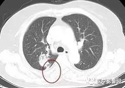 【病例】右肺上叶腺癌1例CT