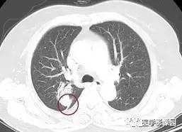 【病例】右肺上叶腺癌1例CT 【病例】右肺上叶腺癌1例CT