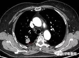 【病例】右肺上叶腺癌1例CT 【病例】右肺上叶腺癌1例CT