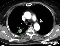 【病例】右肺上叶腺癌1例CT 【病例】右肺上叶腺癌1例CT