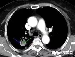 【病例】右肺上叶腺癌1例CT 【病例】右肺上叶腺癌1例CT